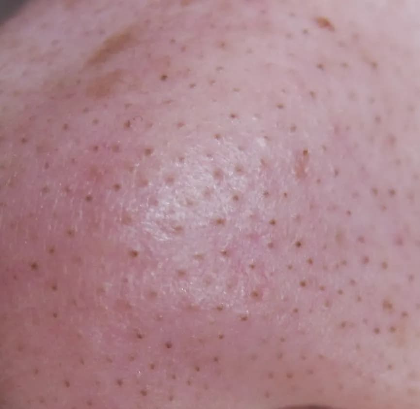 Jak wygląda zapchana cera? 7 oznak, które musisz znać